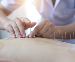 Close-up of acupuncture needles being inserted into a person’s back by a practitioner.